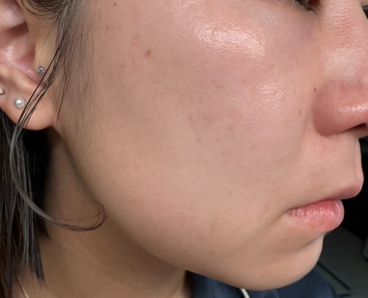 よつば会クリニック 神戸・ハーバーランド院でを受けたまゆさんの写真