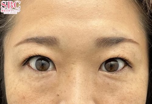 【30代女性・目元】タルミ取り併用全切開法二重・眼瞼下垂_after