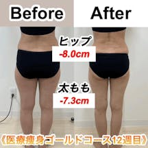 【女性・下半身】医療痩身ゴールドコース_before_aftar