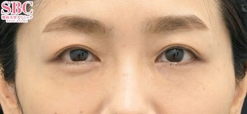 【女性・目元】裏ハムラ法、ナチュラル脂肪注射ナノリッチ_aftar