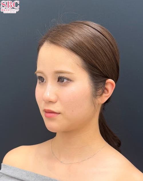 【20代女性・顔・頬・顎下】小顔用脂肪吸引注射(頬・ジョールファット・顎下)・エンブレイスRF・プリマリフト_before