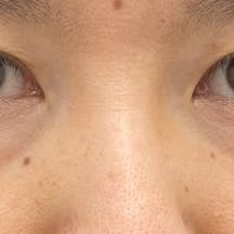 【40代女性・クマ】目の下の切らないクマ・たるみ(ふくらみ)取り ナチュラル脂肪注射コンデンスリッチ ナチュラル脂肪注射ナノリッチ_before