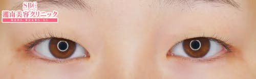 【女性・目元】クイックコスメティーク・ダブルNeo_before