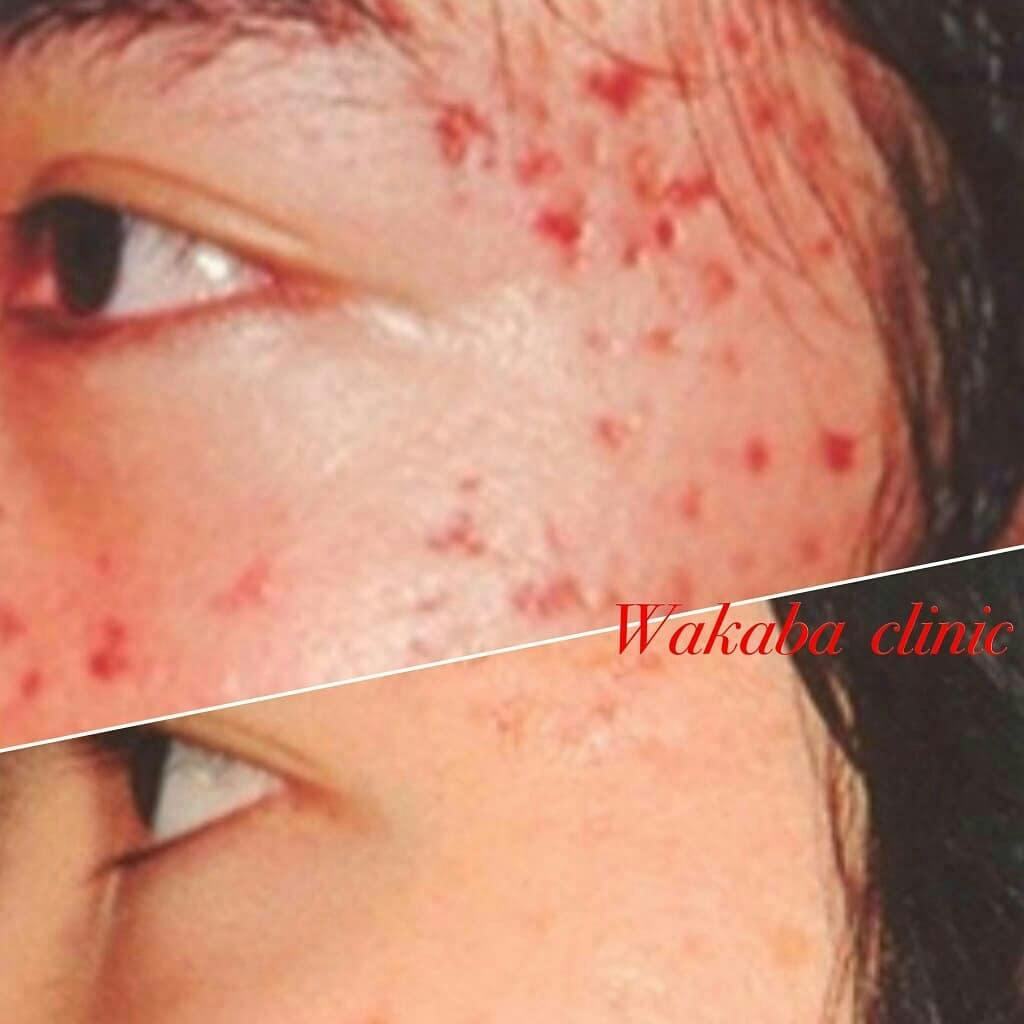 【女性・赤み】Vbeam_before_aftar