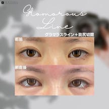 【女性・目元】グラマラスライン+目尻切開_before_aftar