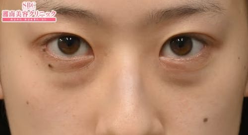 【20代女性・目元】目の下の切らないクマ・たるみ（ふくらみ）取り ナチュラル脂肪注射コンデンスリッチ ナチュラル脂肪注射ナノリッチ_before