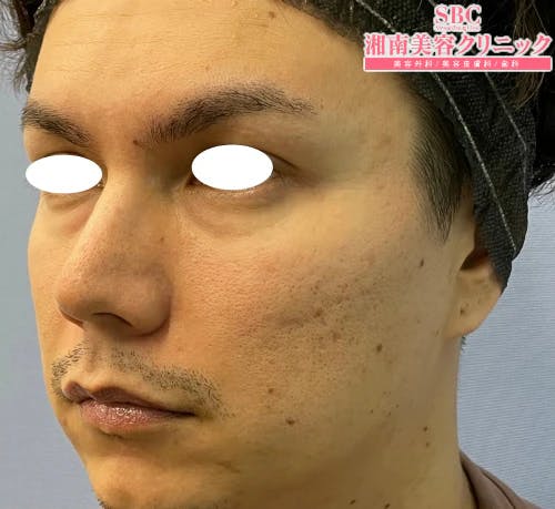 【30代男性・クマ】目の下の切らないクマ・たるみ（ふくらみ）取り_before