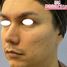 【30代男性・クマ】目の下の切らないクマ・たるみ(ふくらみ)取り_before