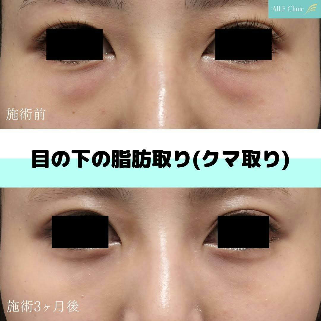 【女性・クマ】目の下の脂肪取り(クマ取り)_before_aftar
