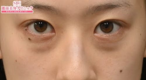 【20代女性・目元】目の下の切らないクマ・たるみ（ふくらみ）取り ナチュラル脂肪注射コンデンスリッチ ナチュラル脂肪注射ナノリッチ_before