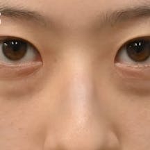 【20代女性・目元】目の下の切らないクマ・たるみ(ふくらみ)取り ナチュラル脂肪注射コンデンスリッチ ナチュラル脂肪注射ナノリッチ_before