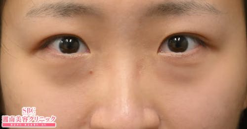 【20代女性・目元】目の下の切らないクマ・たるみ（ふくらみ）取り ナチュラル脂肪注射コンデンスリッチ ナチュラル脂肪注射ナノリッチ_before