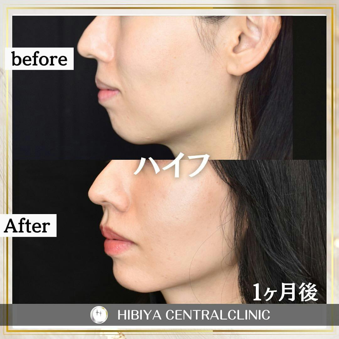 【女性・たるみ】ＨＩＦＵ（ハイフ）_before_aftar