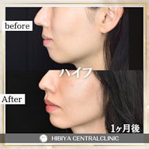 【女性・たるみ】HIFU(ハイフ)_before_aftar