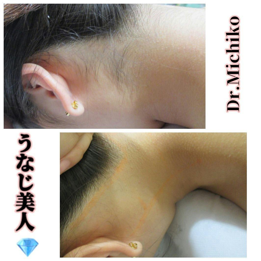 フェミークリニック 池袋院_before_aftar