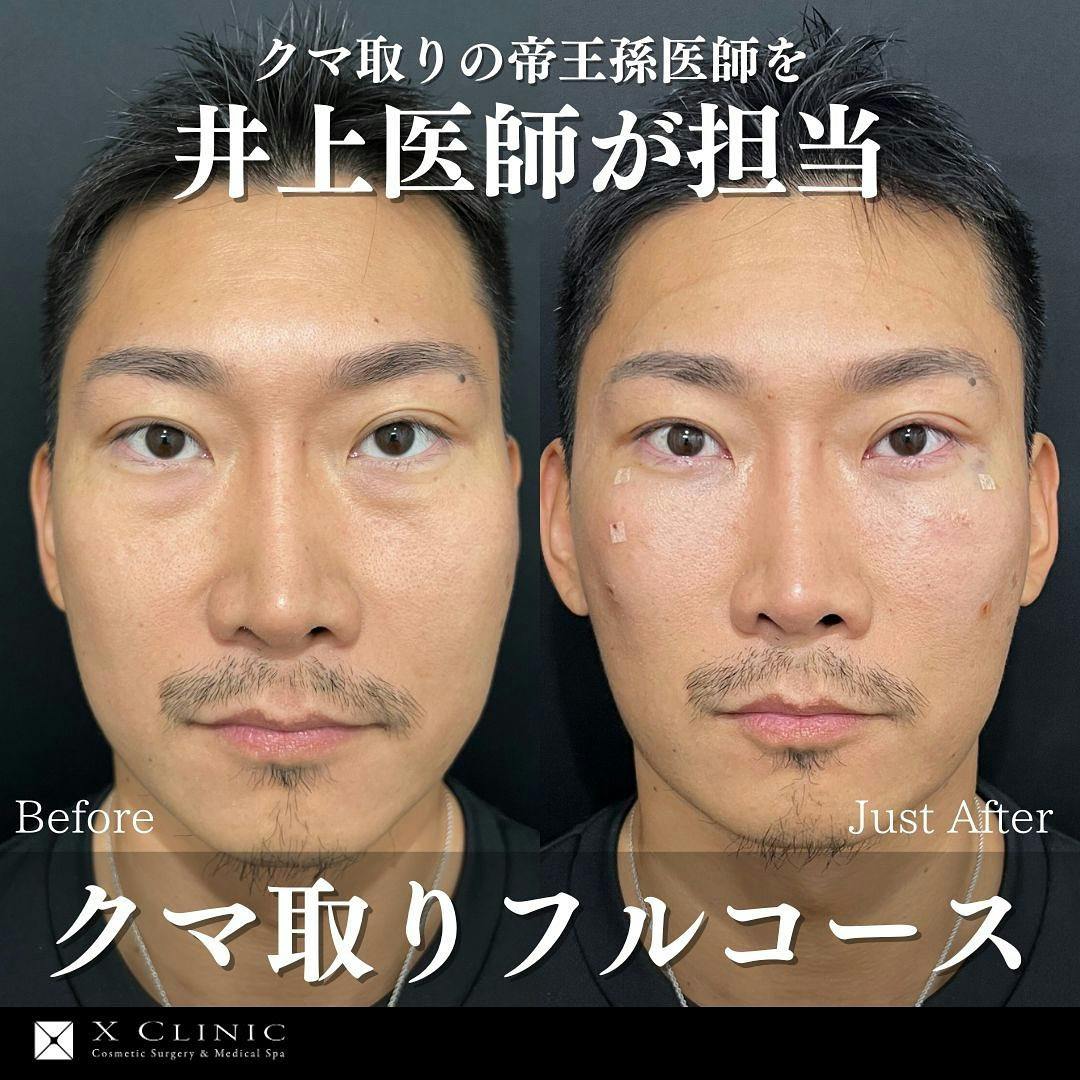 【男性・目元】クマ取りフルコース_before_aftar