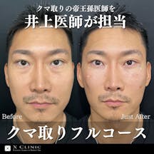 【男性・目元】クマ取りフルコース_before_aftar