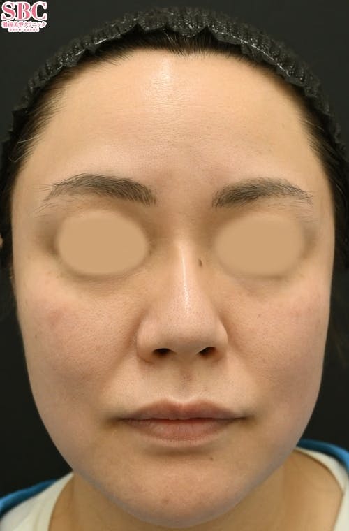 【女性・たるみ】女優注射(R)~リジュラン＋ボトックス~、プロファイロ_before