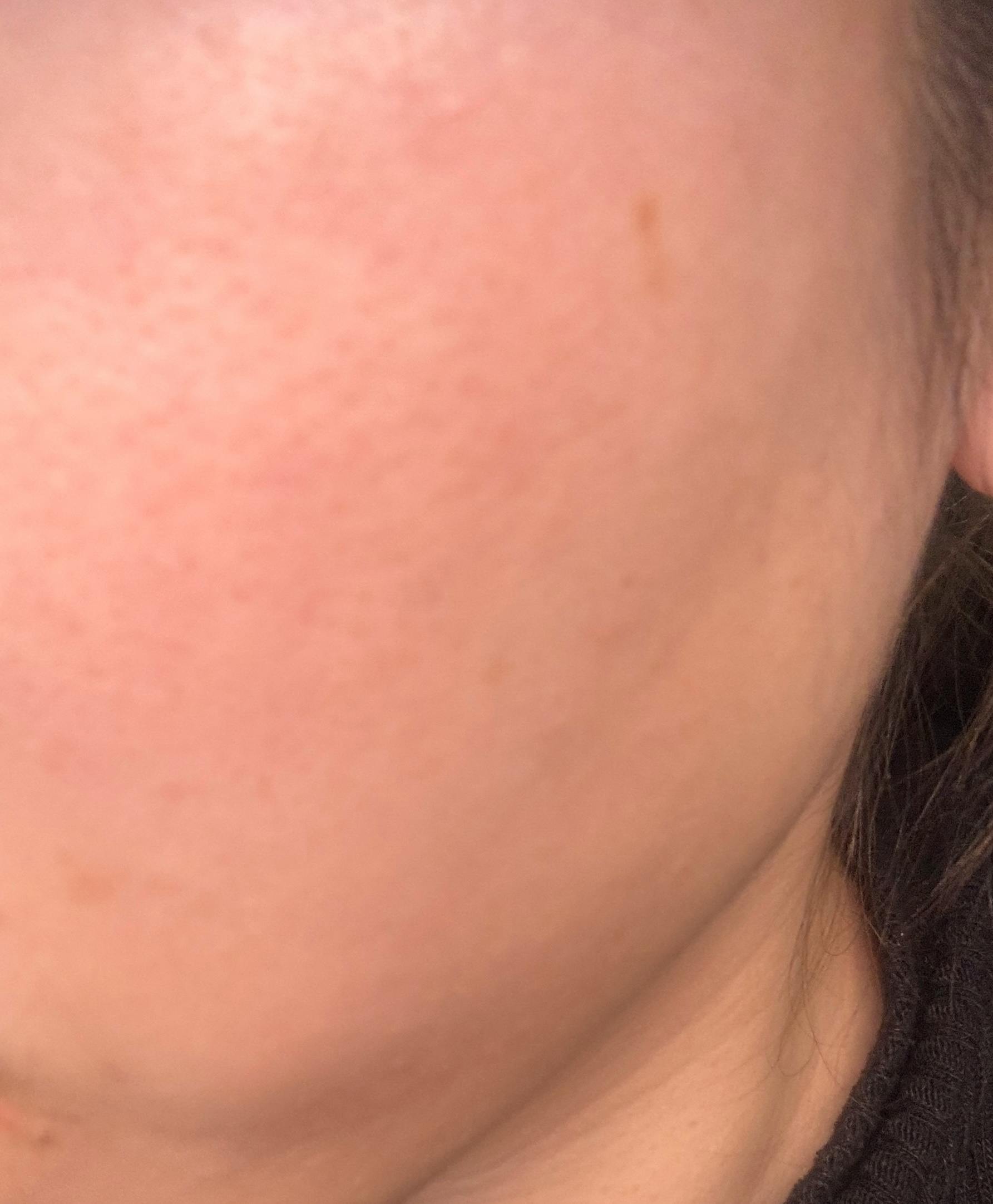 湘南美容クリニック 上野院でIPL光治療(フォトフェイシャル)・フォトフェイシャルステラM22・医療レーザー治療・ノーニードルセラピー・エレクトロポレーション・ケミカルピーリング・サリチル酸マクロゴールピーリング・ピーリング・ピーリング(ボディ)を受けたnaoさんの写真