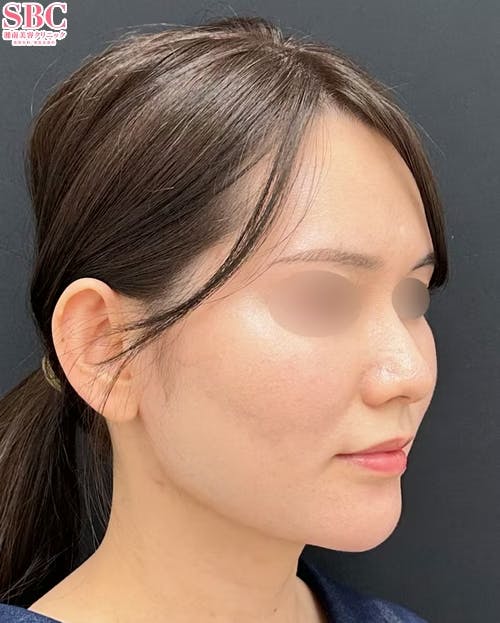 【30代女性・顔】Aquicell(アキーセル)脂肪吸引・ジョールファット除去術・エンブレイスRF_after