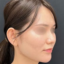 【30代女性・顔】Aquicell(アキーセル)脂肪吸引・ジョールファット除去術・エンブレイスRF_after