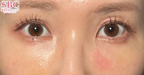 【30代女性・クマ】目の下の切らないクマ・たるみ（ふくらみ）取り、ナチュラル脂肪注射コンデンスリッチ、ナチュラル脂肪注射ナノリッチ_1week