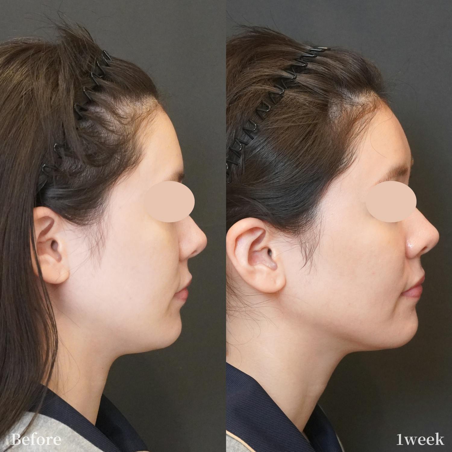 オリジオkiss_before_after