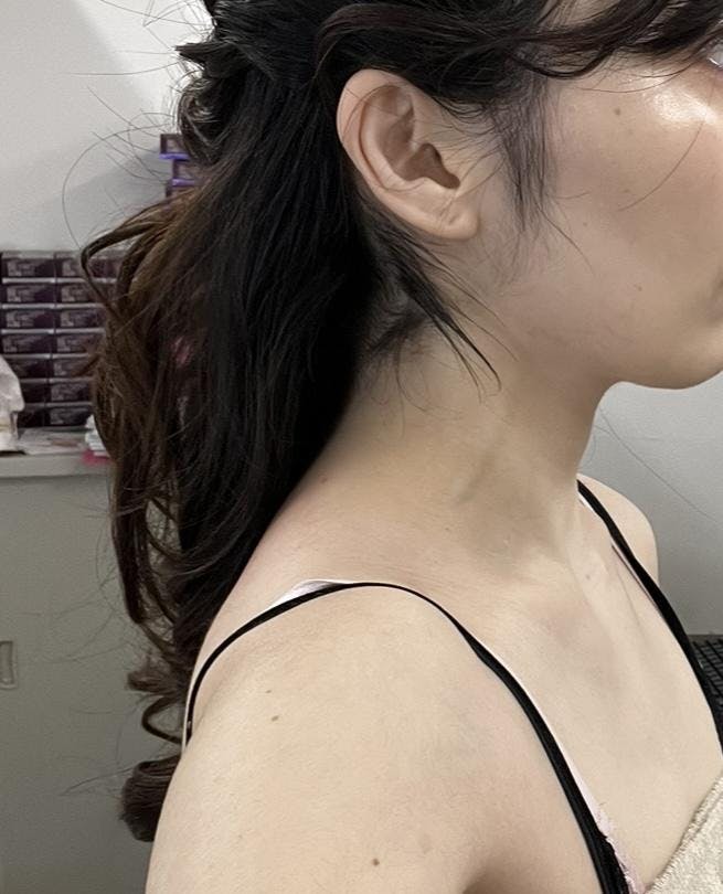 アンリクリニック 名古屋院(Henri Clinic)で肩ボトックスを受けたayaさんの写真