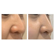 【女性・鼻】小顔注射_before_aftar