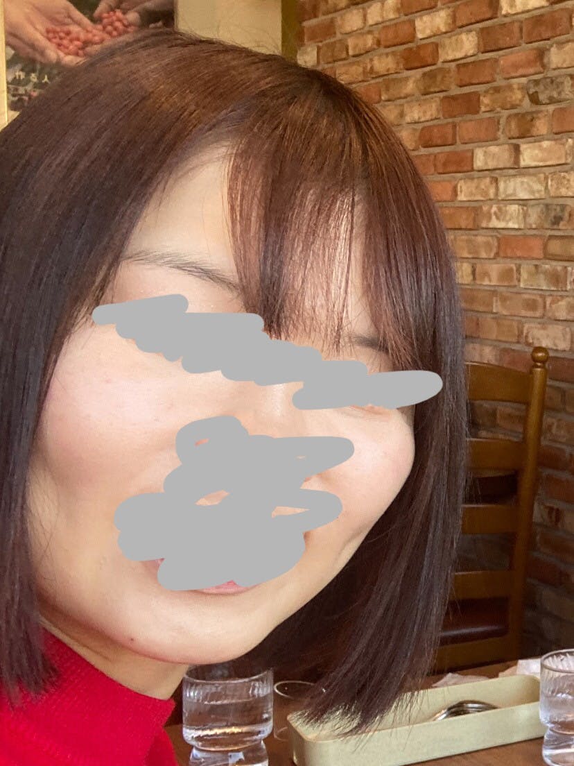 湘南美容クリニック 品川院でを受けた山藤さんの写真