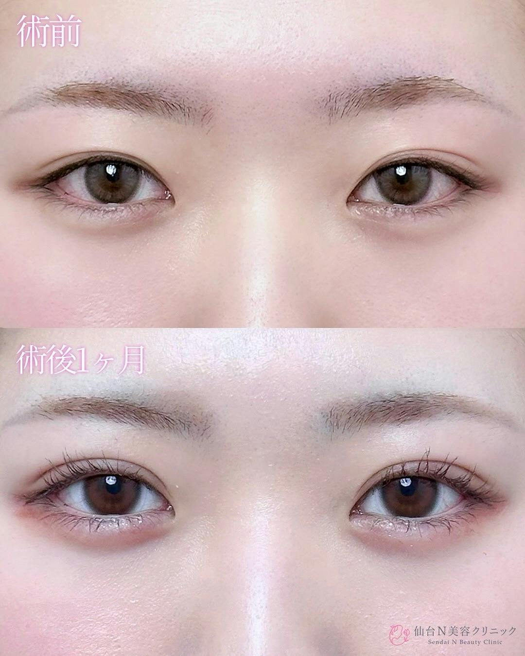 【女性・目元】二重埋没法（シークレットトリプル）_before_aftar