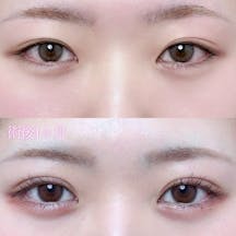 【女性・目元】二重埋没法(シークレットトリプル)_before_aftar