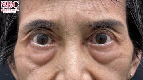 【70代女性・目元】眼瞼下垂＋二重 タルミ取り併用全切開法二重_after