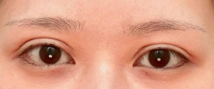 ビアンカ 銀座院(BIANCA)で目の整形：睫毛上皮膚切除（ハム目修正）を受けたゆずぽんさんの写真