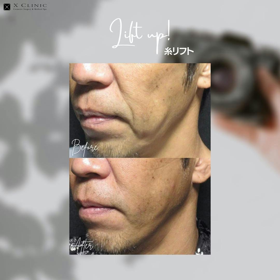 【男性・たるみ】糸リフト_before_aftar