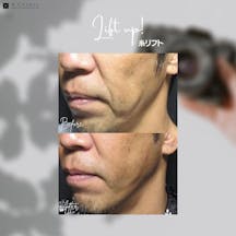 【男性・たるみ】糸リフト_before_aftar