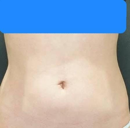 ワムクリニック銀座(WOM CLINIC GINZA)でボディ脂肪吸引：腰の脂肪吸引を受けたNENEさんの写真