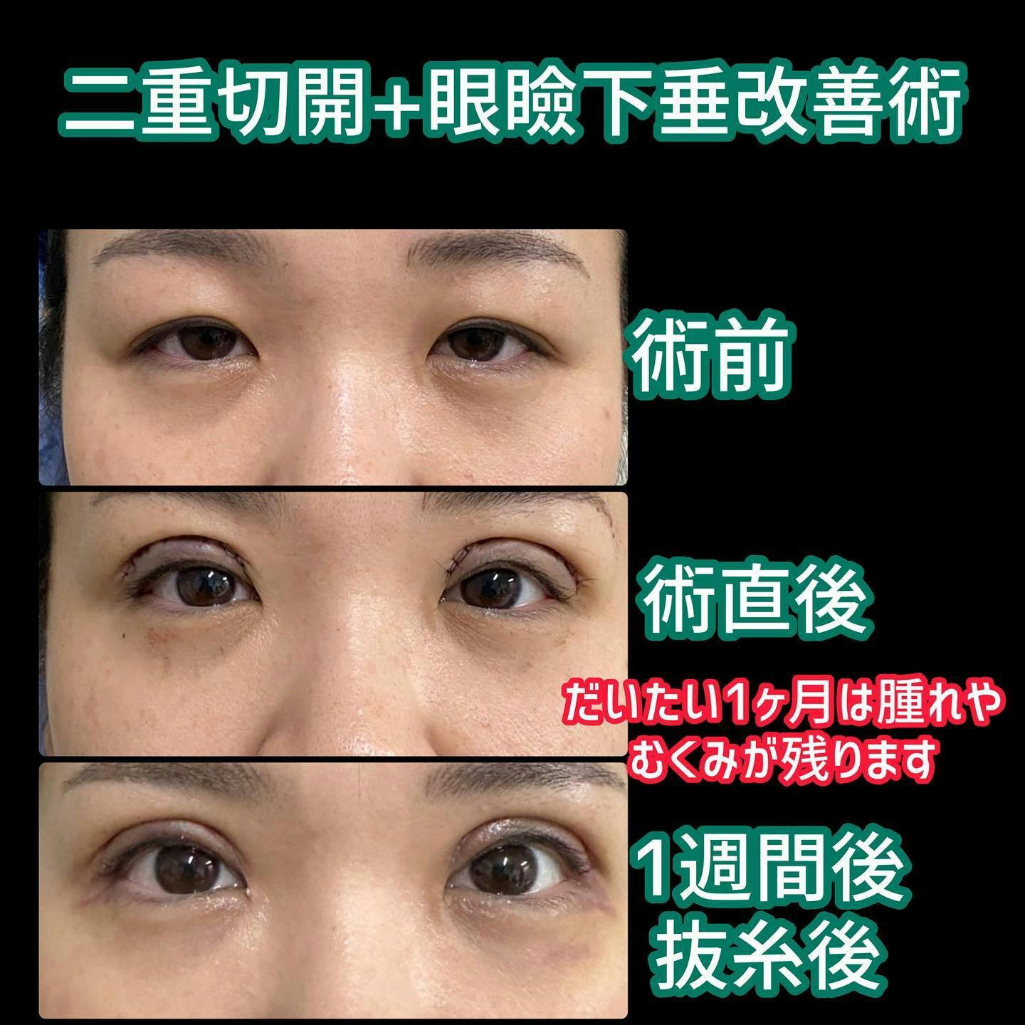 【女性・目元】二重切開＋眼瞼下垂改善術_before_aftar