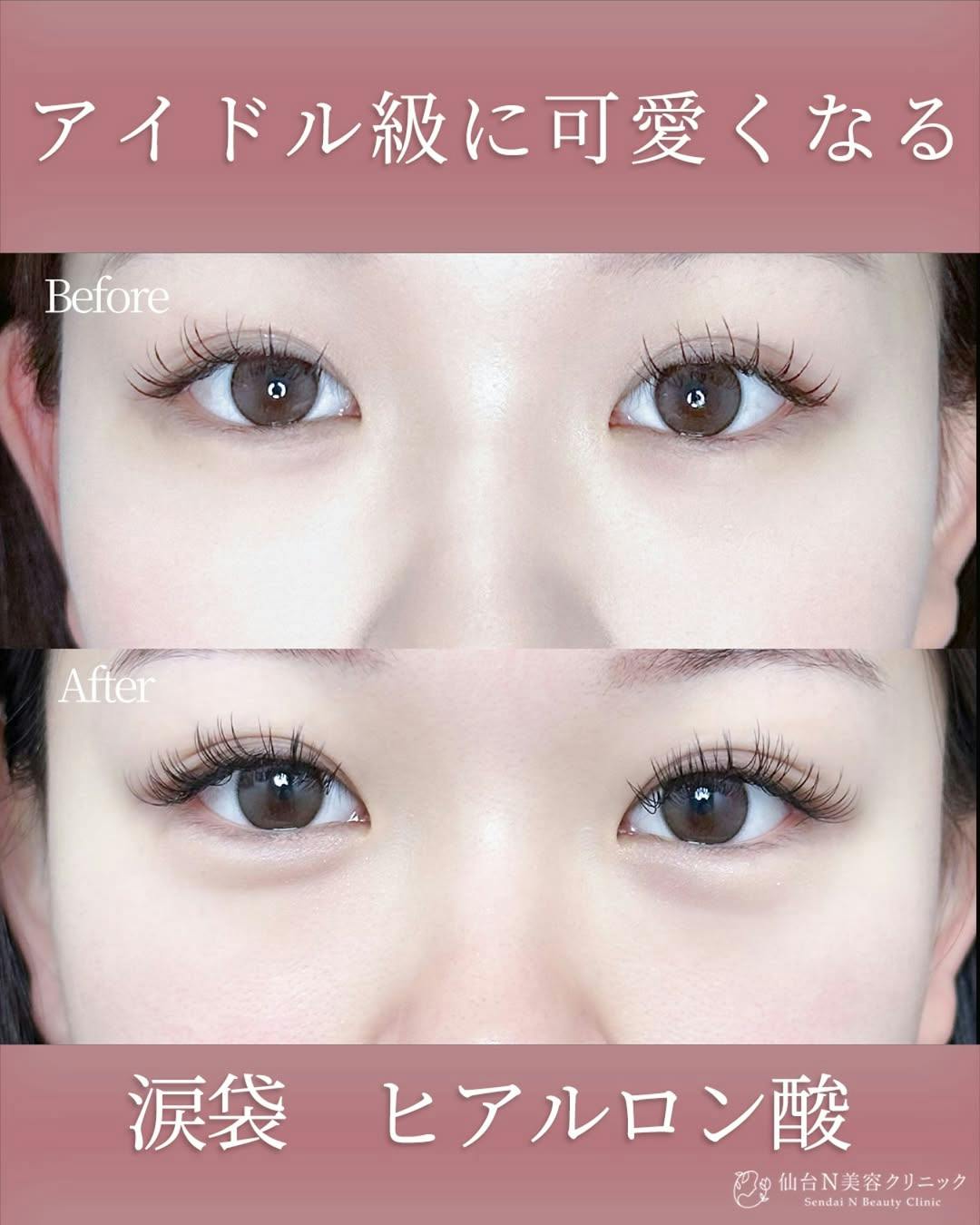 【女性・涙袋】ヒアルロン酸 ボルベラ_before_aftar