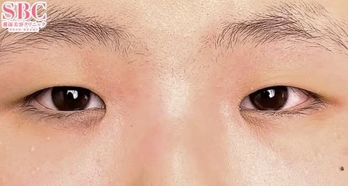 【10代女性・目元】クイックコスメティーク・ダブルNeo_before