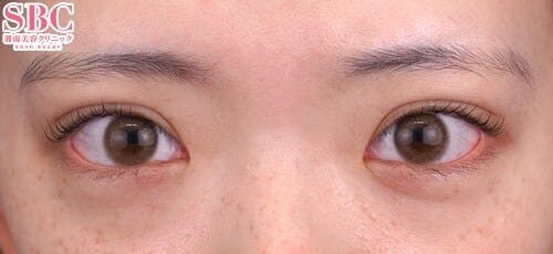 【10代女性・目元】クイックコスメティーク・トリプルNeo_after