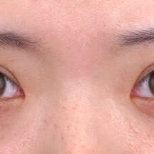 【10代女性・目元】クイックコスメティーク・トリプルNeo_after