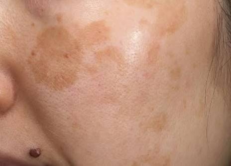 渋谷美容外科クリニック 渋谷院で医療レーザー脱毛（女性パーツプラン）：顔全体 5回を受けたやまちゃんさんの写真