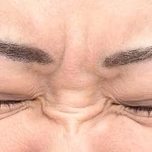 【30代後半女性・シワ】ボトックス(アラガン)_before