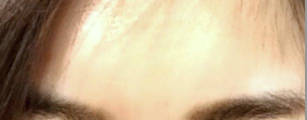 さわこ形成外科クリニックでボトックスを受けたMさんの写真