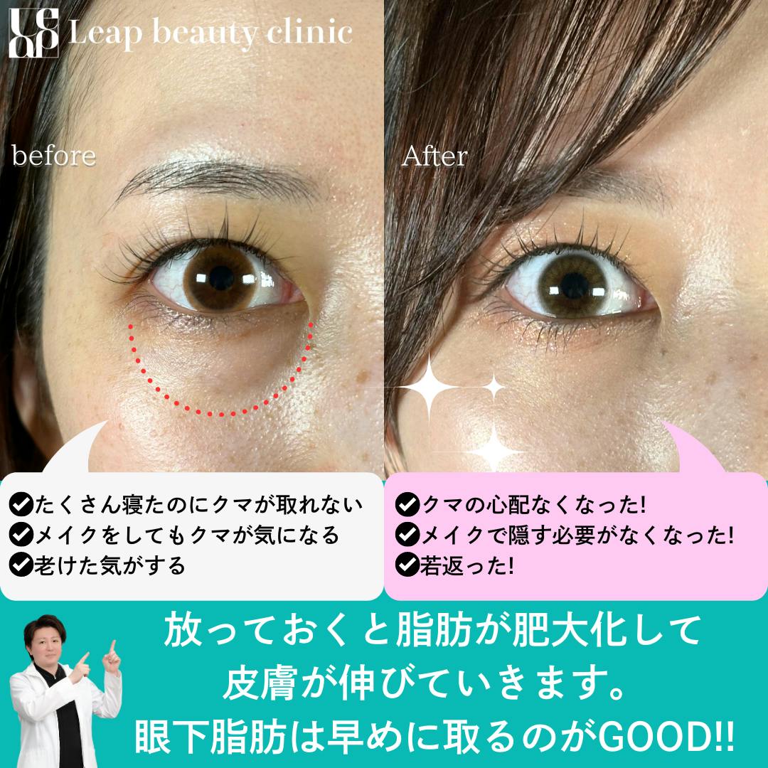 【20代女性・目元】目の下のたるみ取り_before_aftar
