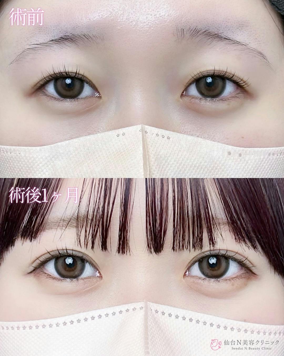 【女性・目元】二重埋没法（シークレットトリプル）_before_aftar