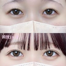 【女性・目元】二重埋没法(シークレットトリプル)_before_aftar
