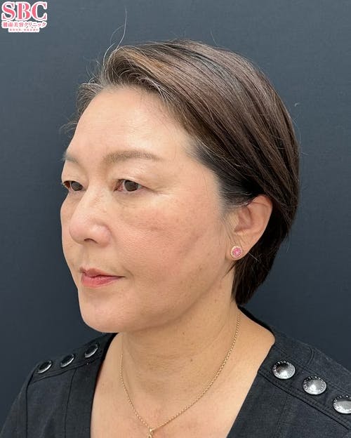 【50代女性・顔・目元】プリマリフト・目の下の切らないクマ・たるみ(ふくらみ)取り・ナチュラル脂肪注射コンデンスリッチ_after