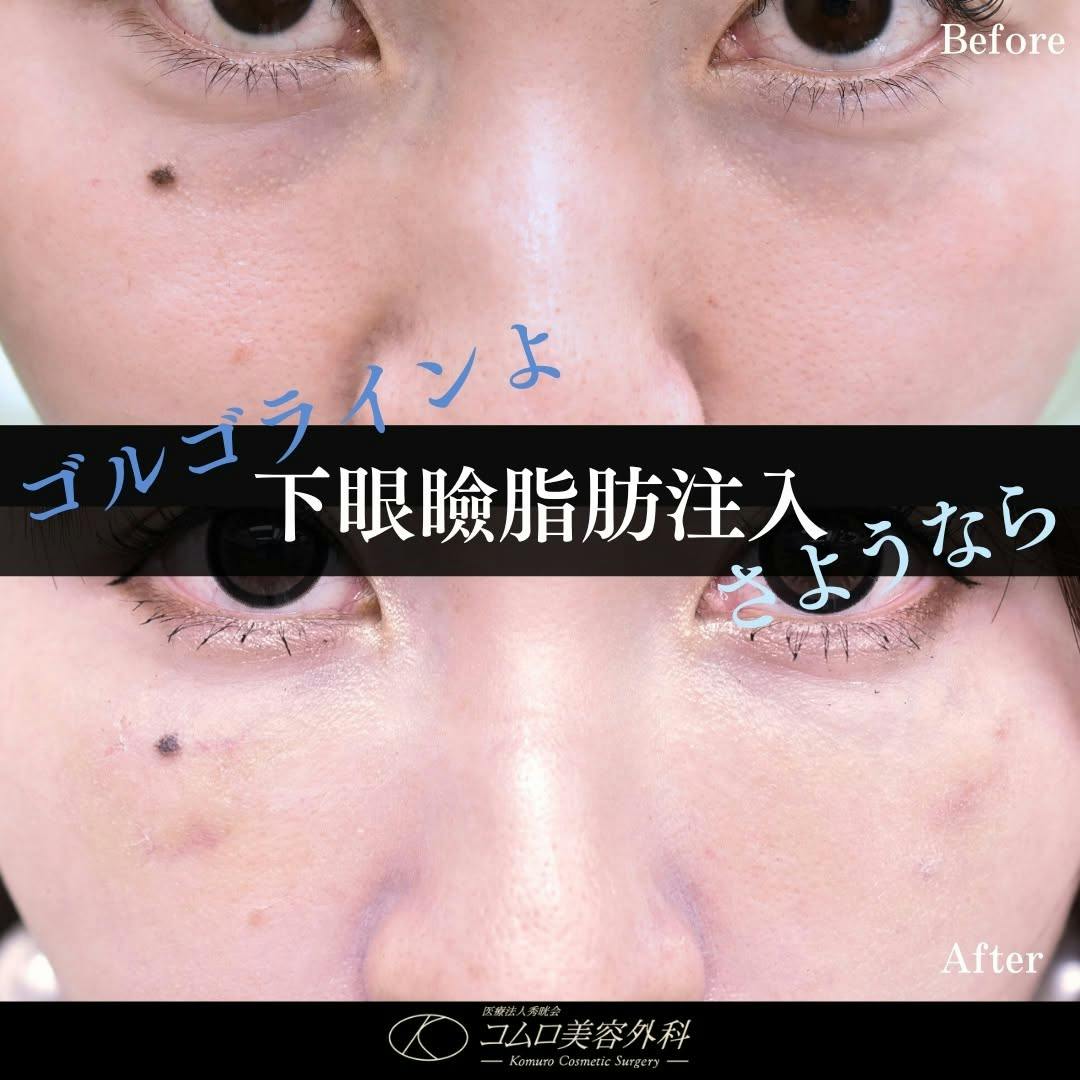 【30代女性・目元】下眼瞼脂肪注入_before_aftar